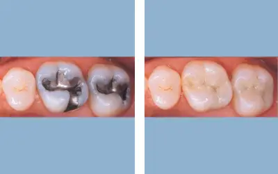 Before and After
